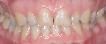 Zähne vor der Behandlung mit Veneers