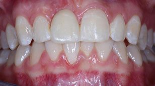 Zähne nach der Behandlung mit Klebebrücken