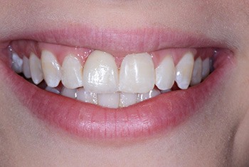 Zähne nach der Behandlung mit Klebebrücken