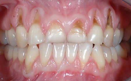 Zustand des Zahnfleisches vor der Behandlung