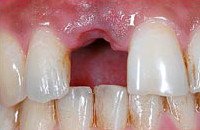 Extrahierter Zahn