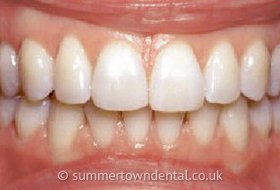 Zähne nach der Zahnregulierung