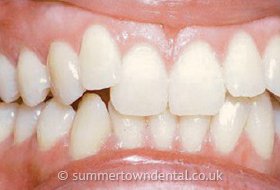 Zähne vor der Zahnregulierung
