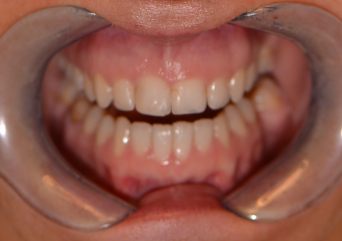 Patientenfall: Zähne vor der Behandlung mit Kronen
