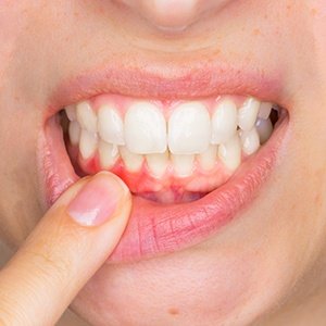 Zahnfleisch-Programm Charvat
