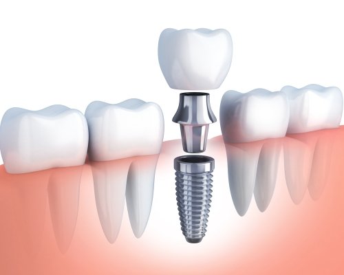 Querschnitt Implantat