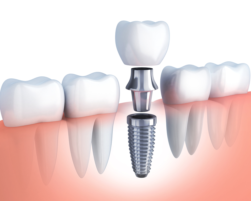 Implantate Implantologie In Der Zahnarztordination Dr Charvat
