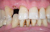 Abgebrochener Zahn