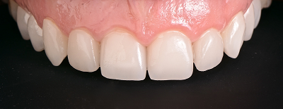 Zähne nach der Behandlung mit Veneers