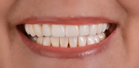 Zähne nach der Behandlung mit Veneers