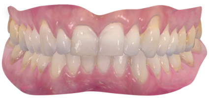 Digitaler Zahnabdruck der Zähne
