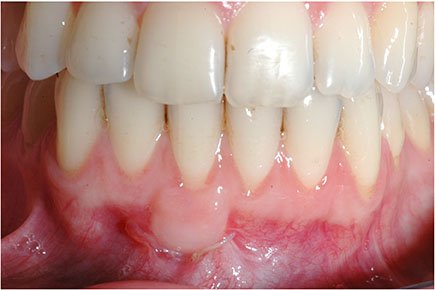 Zustand des Zahnfleisches nach der Behandlung