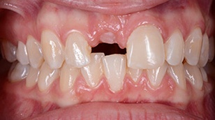 Zähne vor der Behandlung mit Klebebrücken