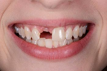 Zähne vor der Behandlung mit Klebebrücken