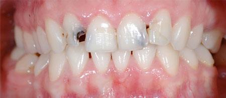 Zähne vor der Behandlung mit Veneers