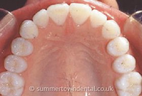 Zähne nach der Zahnspangen