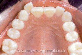 Zähne vor der Zahnregulierung