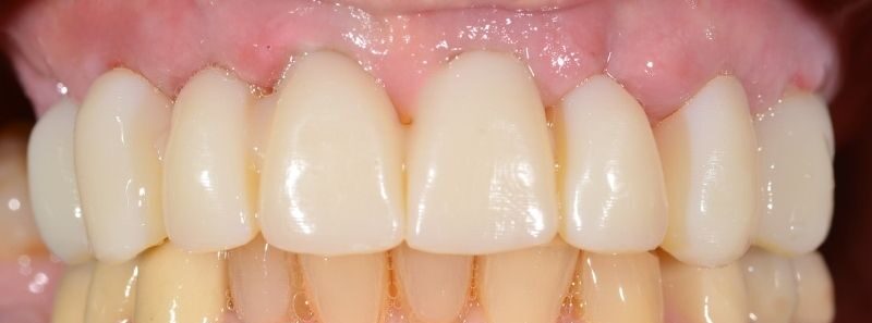 3 Stunden nach der OP