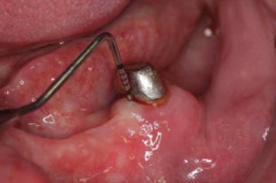 Zahnfleisch wird mit Laser behandelt