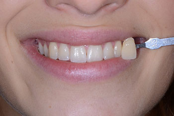 A2 oder zahnfarbe a1 contrensubshea: Zahnfarbe