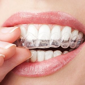 Zahnregulierung Charvat